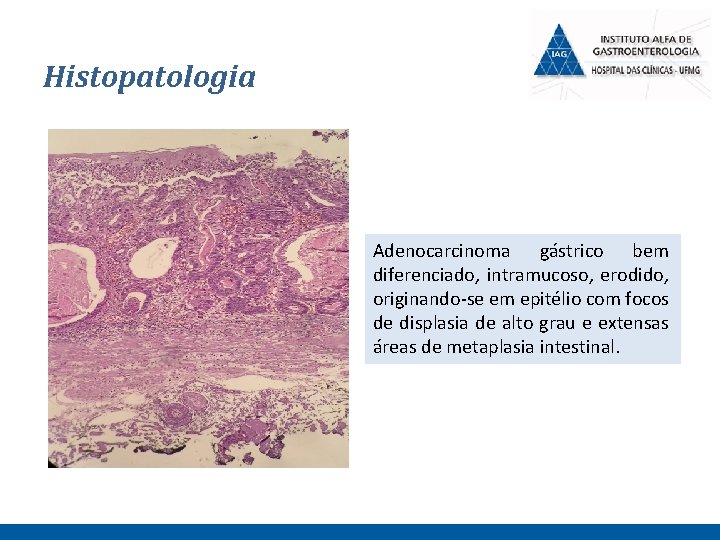 Histopatologia Adenocarcinoma gástrico bem diferenciado, intramucoso, erodido, originando-se em epitélio com focos de displasia