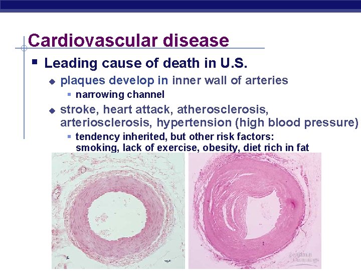 Cardiovascular disease § Leading cause of death in U. S. u plaques develop in