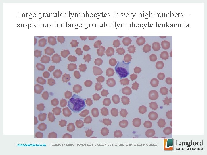 Large granular lymphocytes in very high numbers – suspicious for large granular lymphocyte leukaemia