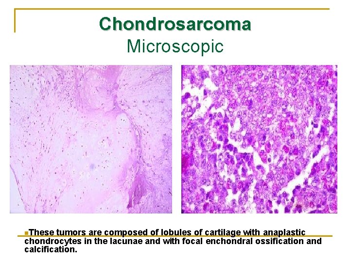 Chondrosarcoma Microscopic n. These tumors are composed of lobules of cartilage with anaplastic chondrocytes Chondrosarcoma Microscopic n. These tumors are composed of lobules of cartilage with anaplastic chondrocytes