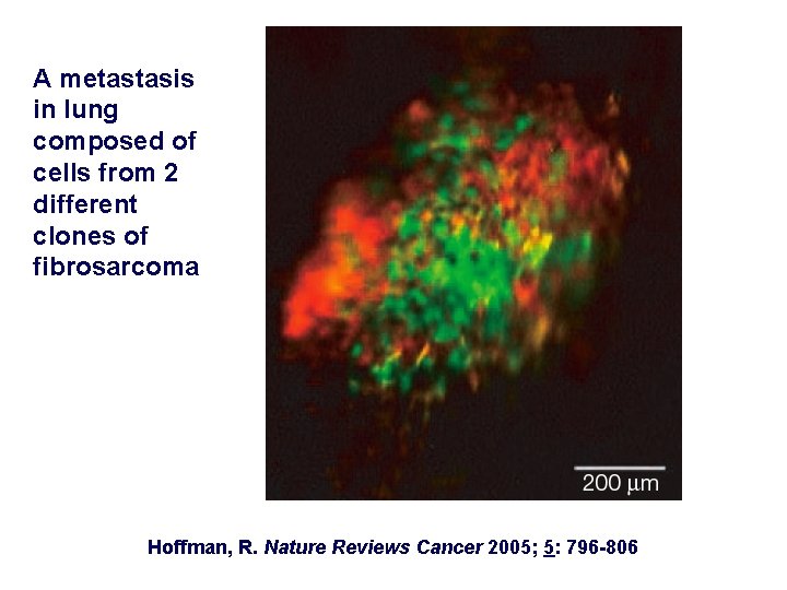 A metastasis in lung composed of cells from 2 different clones of fibrosarcoma Hoffman,