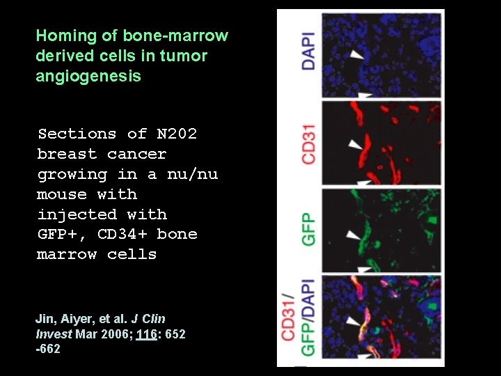 Homing of bone-marrow derived cells in tumor angiogenesis Sections of N 202 breast cancer