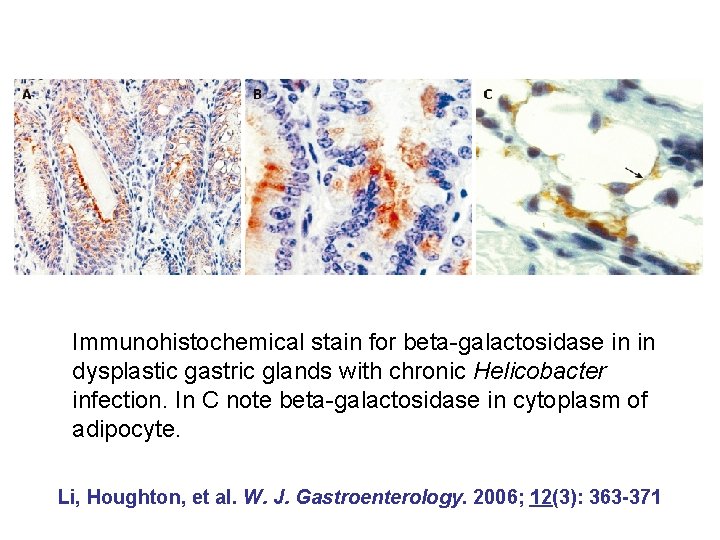 Immunohistochemical stain for beta-galactosidase in in dysplastic gastric glands with chronic Helicobacter infection. In