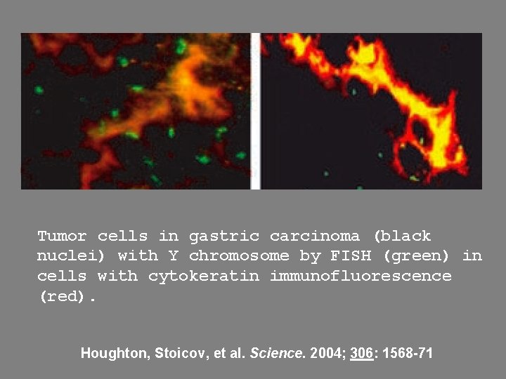 Tumor cells in gastric carcinoma (black nuclei) with Y chromosome by FISH (green) in