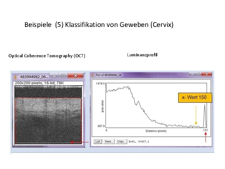 Beispiele (5) Klassifikation von Geweben (Cervix) Optical Coherence Tomography (OCT) Luminanzprofil 