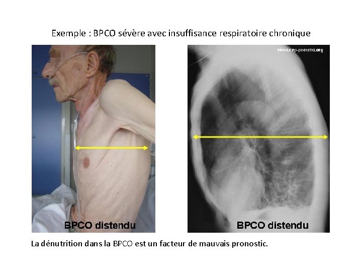 Exemple : BPCO sévère avec insuffisance respiratoire chronique La dénutrition dans la BPCO est