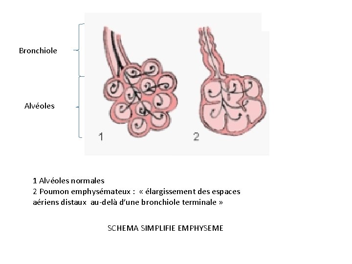 Bronchiole Alvéoles 1 Alvéoles normales 2 Poumon emphysémateux : « élargissement des espaces aériens