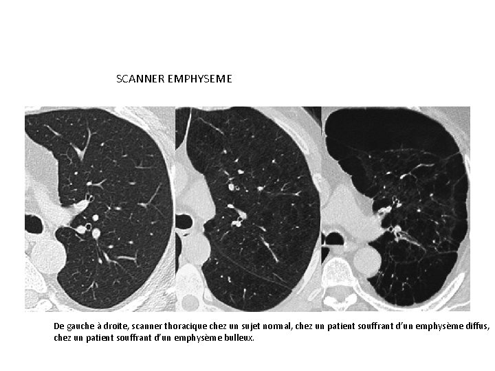 SCANNER EMPHYSEME De gauche à droite, scanner thoracique chez un sujet normal, chez un