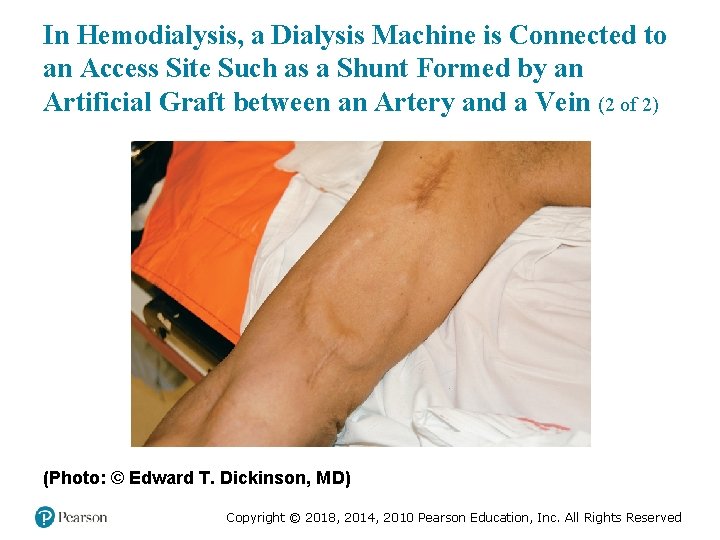In Hemodialysis, a Dialysis Machine is Connected to an Access Site Such as a