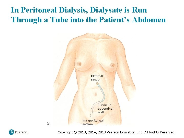 In Peritoneal Dialysis, Dialysate is Run Through a Tube into the Patient’s Abdomen Copyright