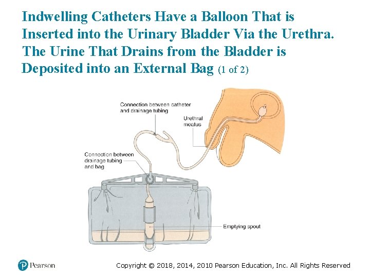 Indwelling Catheters Have a Balloon That is Inserted into the Urinary Bladder Via the