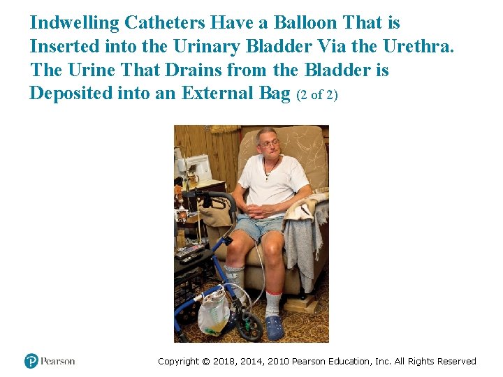 Indwelling Catheters Have a Balloon That is Inserted into the Urinary Bladder Via the