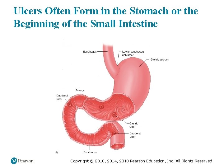 Ulcers Often Form in the Stomach or the Beginning of the Small Intestine Copyright