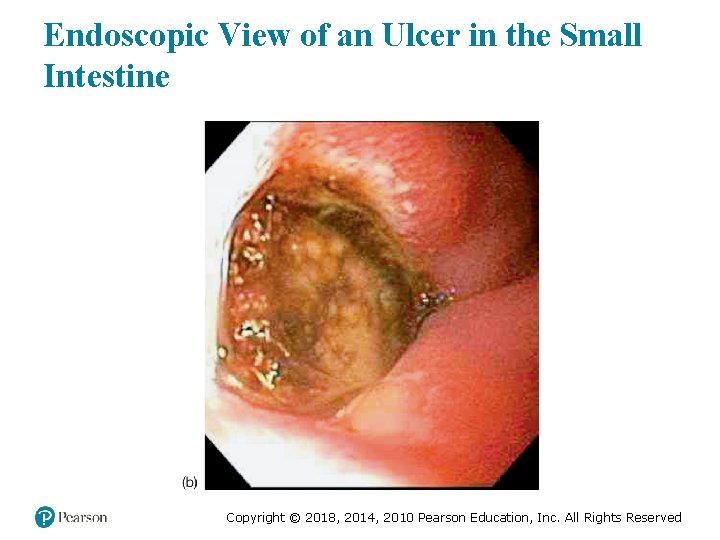 Endoscopic View of an Ulcer in the Small Intestine Copyright © 2018, 2014, 2010
