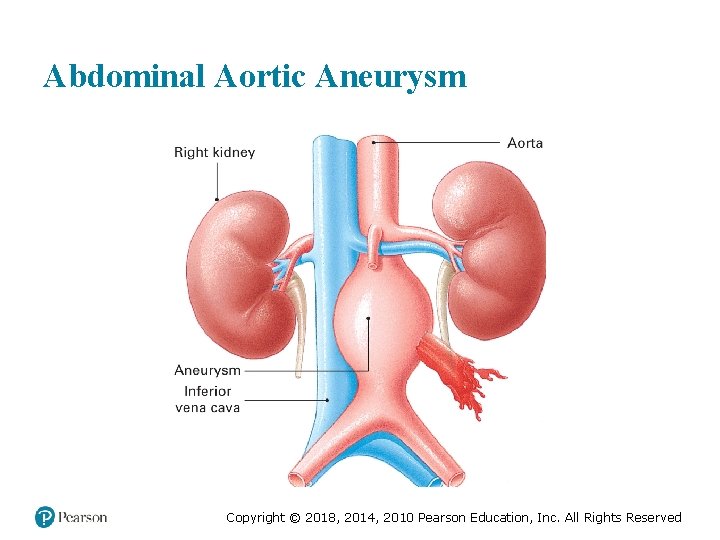 Abdominal Aortic Aneurysm Copyright © 2018, 2014, 2010 Pearson Education, Inc. All Rights Reserved