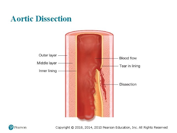Aortic Dissection Copyright © 2018, 2014, 2010 Pearson Education, Inc. All Rights Reserved 