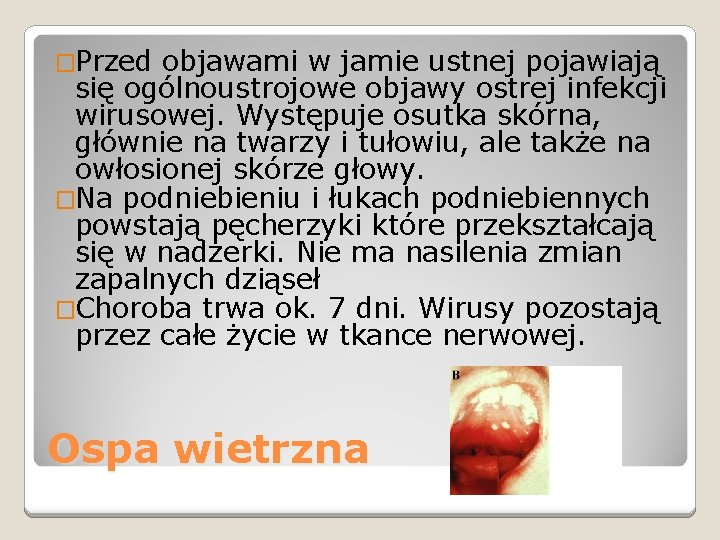 �Przed objawami w jamie ustnej pojawiają się ogólnoustrojowe objawy ostrej infekcji wirusowej. Występuje osutka