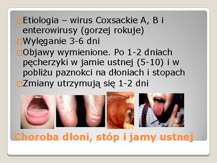 �Etiologia – wirus Coxsackie A, B i enterowirusy (gorzej rokuje) �Wylęganie 3 -6 dni