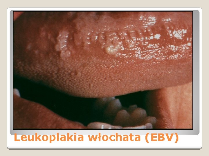 Leukoplakia włochata (EBV) 