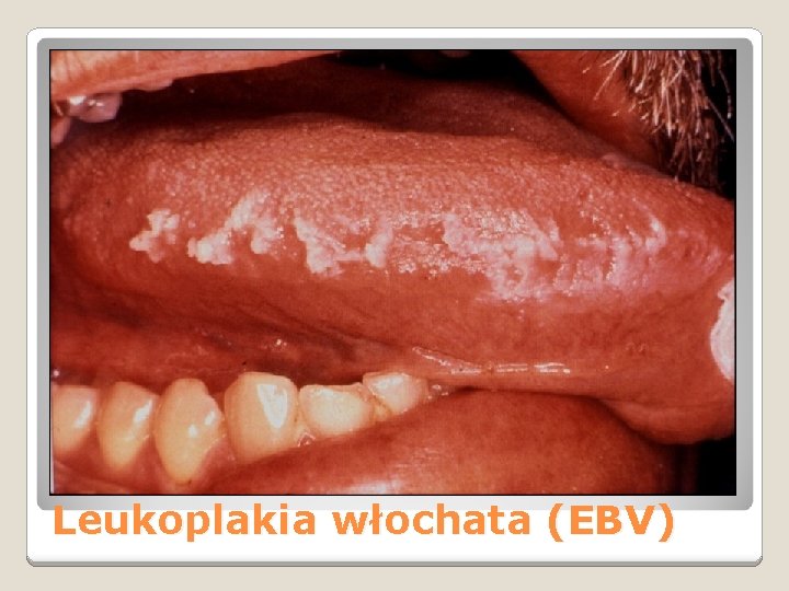 Leukoplakia włochata (EBV) 