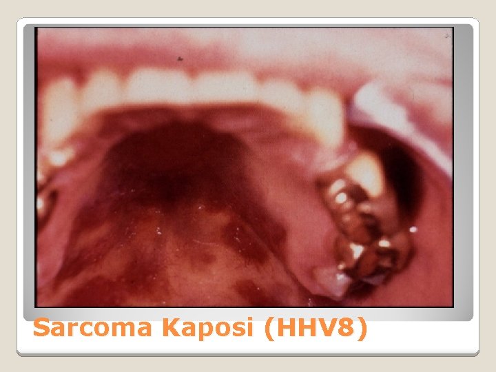 Sarcoma Kaposi (HHV 8) 