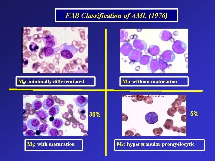 FAB Classification of AML (1976) M 0: minimally differentiated M 1: without maturation 30%