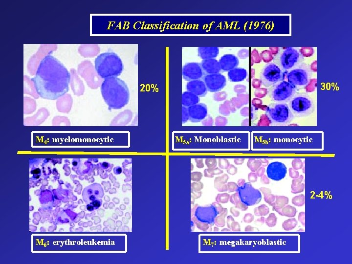 FAB Classification of AML (1976) 30% 20% M 4: myelomonocytic M 5 a: Monoblastic