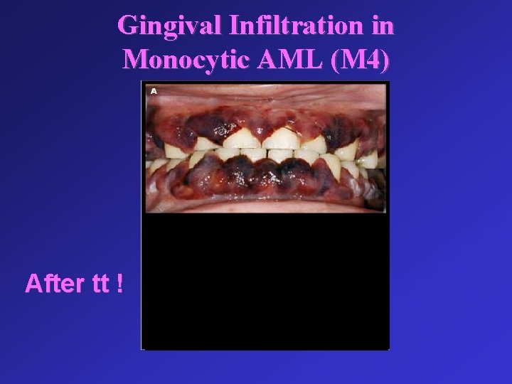 Gingival Infiltration in Monocytic AML (M 4) After tt ! 