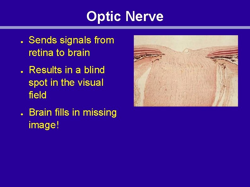 Optic Nerve ● ● ● Sends signals from retina to brain Results in a