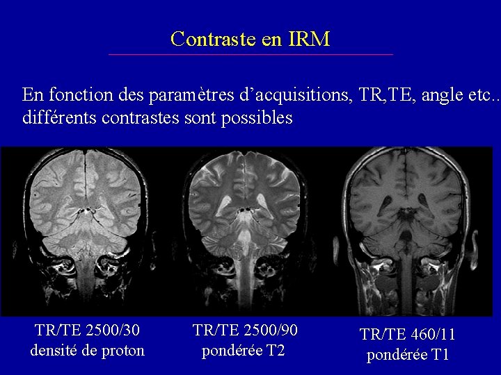 Contraste en IRM En fonction des paramètres d’acquisitions, TR, TE, angle etc. . différents