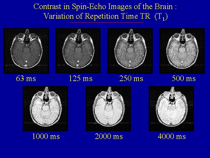 Contrast in Spin-Echo Images of the Brain : Variation of Repetition Time TR (T