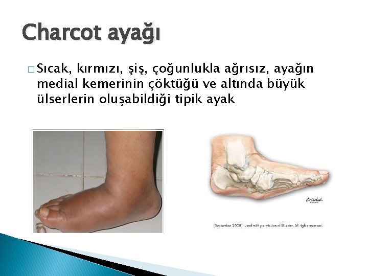 Charcot ayağı � Sıcak, kırmızı, şiş, çoğunlukla ağrısız, ayağın medial kemerinin çöktüğü ve altında