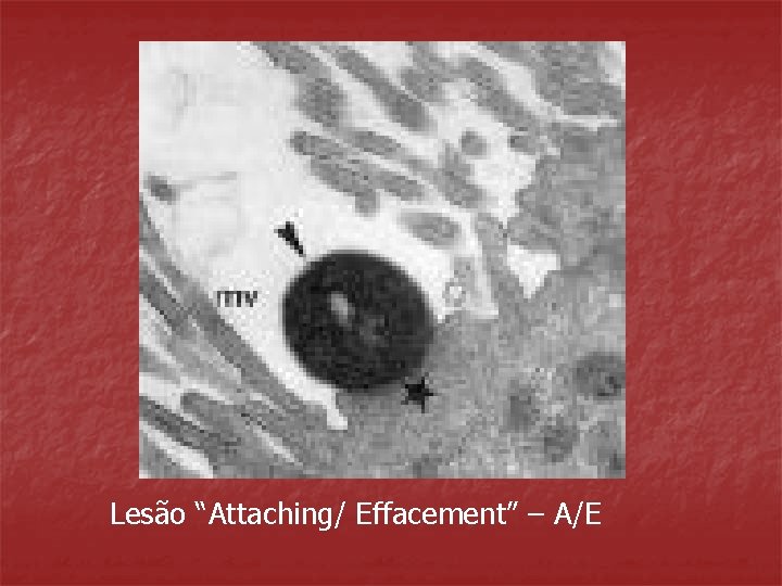 Lesão “Attaching/ Effacement” – A/E 