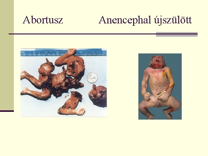 Abortusz Anencephal újszülött 