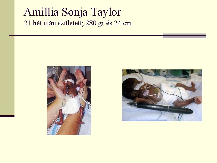 Amillia Sonja Taylor 21 hét után született; 280 gr és 24 cm 