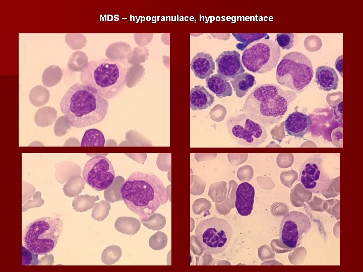 MDS – hypogranulace, hyposegmentace 