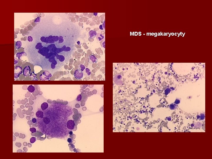 MDS - megakaryocyty 