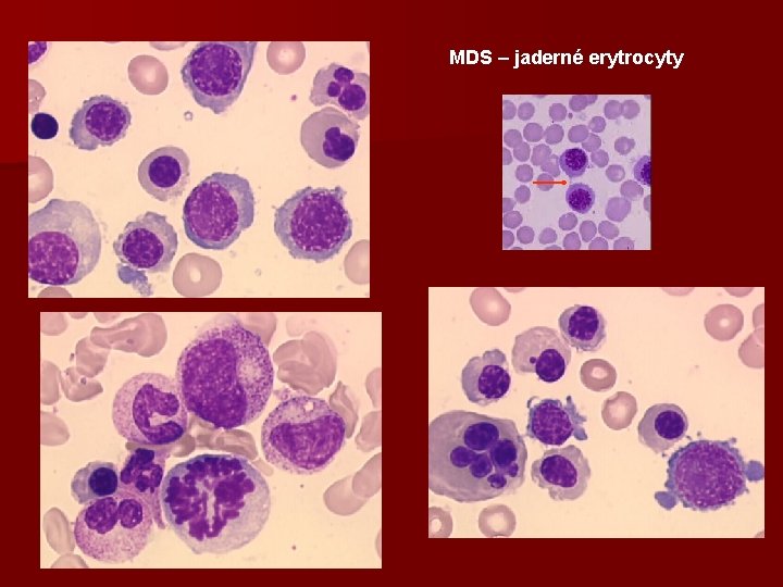 MDS – jaderné erytrocyty 