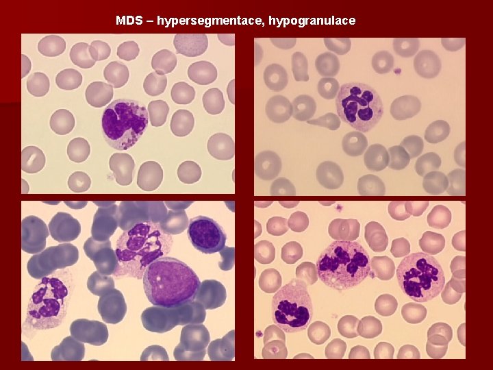 MDS – hypersegmentace, hypogranulace 