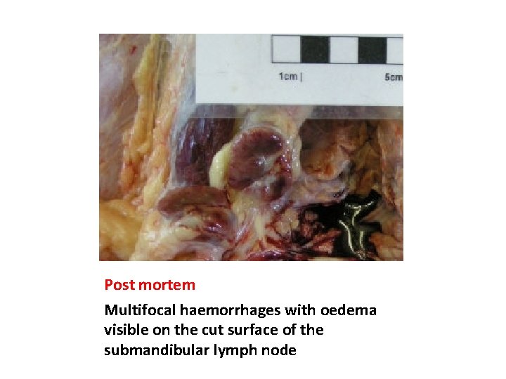 Post mortem Multifocal haemorrhages with oedema visible on the cut surface of the submandibular