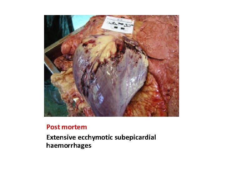 Post mortem Extensive ecchymotic subepicardial haemorrhages 