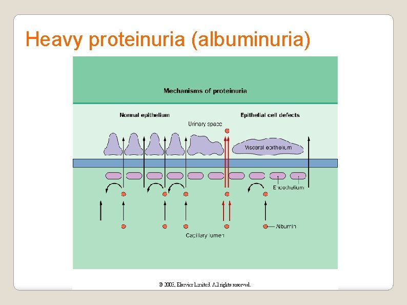 Heavy proteinuria (albuminuria) 
