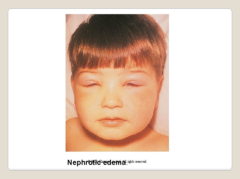 Nephrotic edema. 