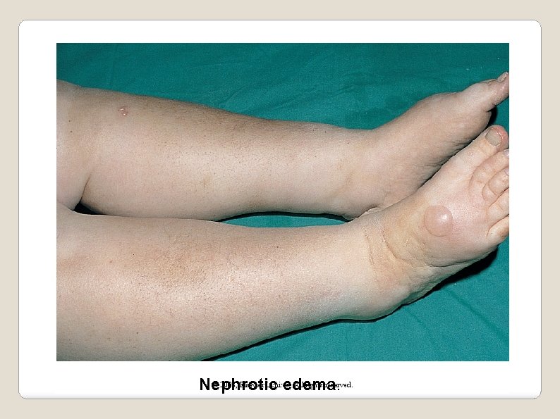 Nephrotic edema. 