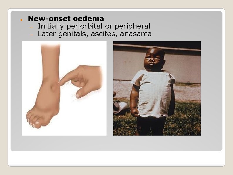  New-onset oedema Initially periorbital or peripheral Later genitals, ascites, anasarca 