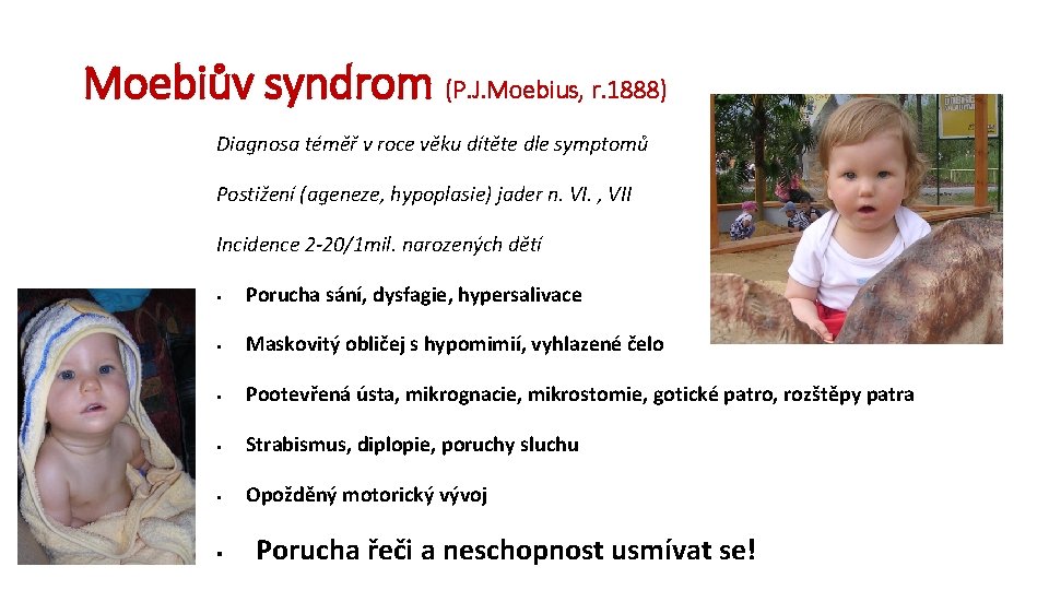 Moebiův syndrom (P. J. Moebius, r. 1888) Diagnosa téměř v roce věku dítěte dle
