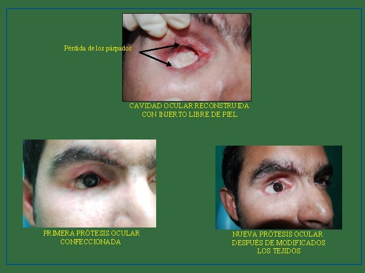 Pérdida de los párpados CAVIDAD OCULAR RECONSTRUIDA CON INJERTO LIBRE DE PIEL PRIMERA PRÓTESIS