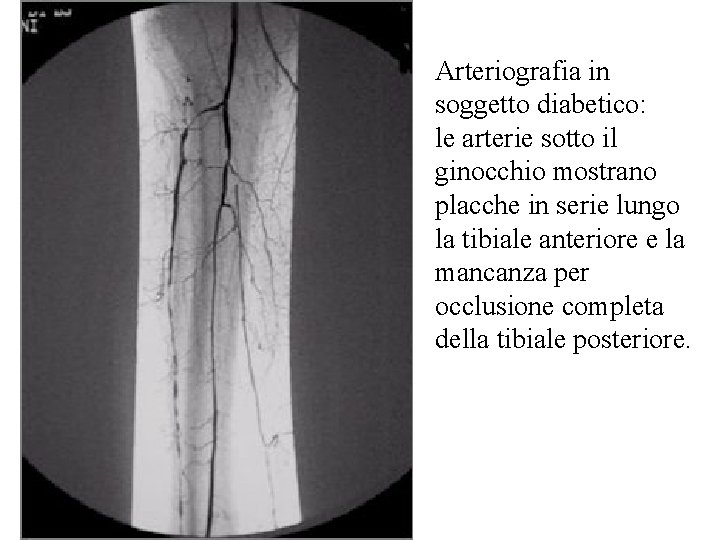 Arteriografia in soggetto diabetico: le arterie sotto il ginocchio mostrano placche in serie lungo