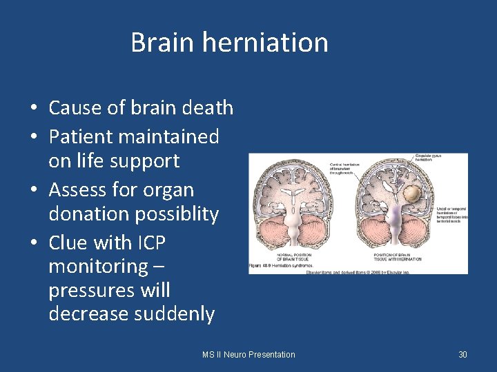 Brain herniation • Cause of brain death • Patient maintained on life support •