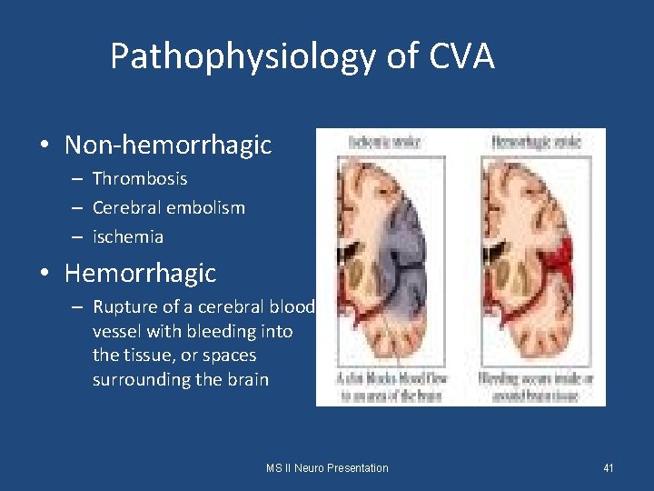 Pathophysiology of CVA • Non-hemorrhagic – Thrombosis – Cerebral embolism – ischemia • Hemorrhagic